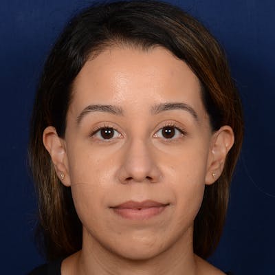 Female Rhinoplasty Before & After Gallery - Patient 275752 - Image 1