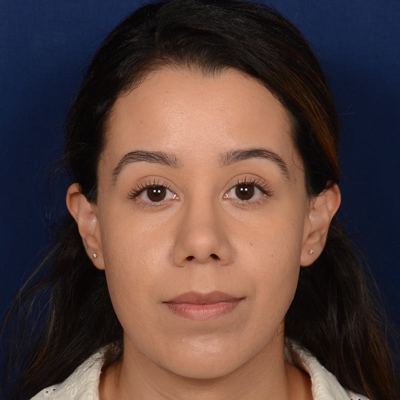 Female Rhinoplasty Before & After Gallery - Patient 275752 - Image 2