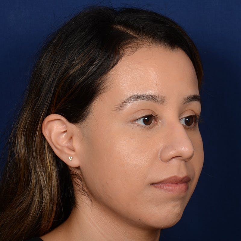 Female Rhinoplasty Before & After Gallery - Patient 275752 - Image 3