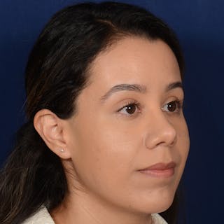 Female Rhinoplasty Before & After Gallery - Patient 275752 - Image 4