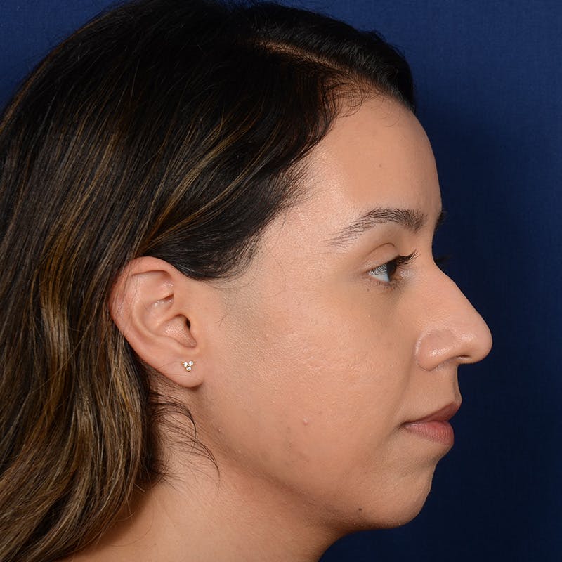 Female Rhinoplasty Before & After Gallery - Patient 275752 - Image 5