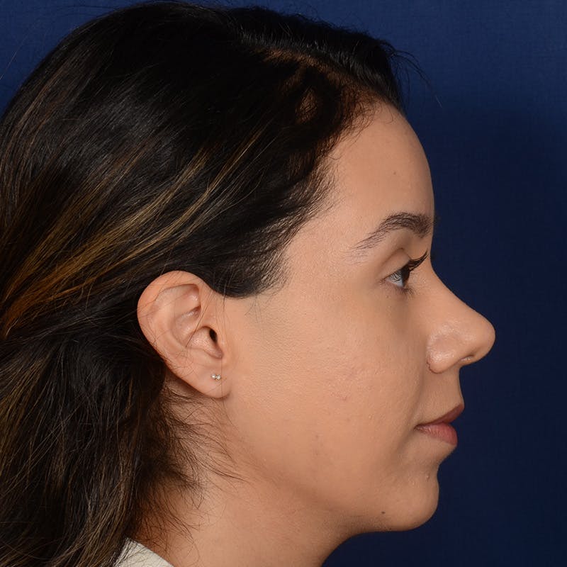 Female Rhinoplasty Before & After Gallery - Patient 275752 - Image 6