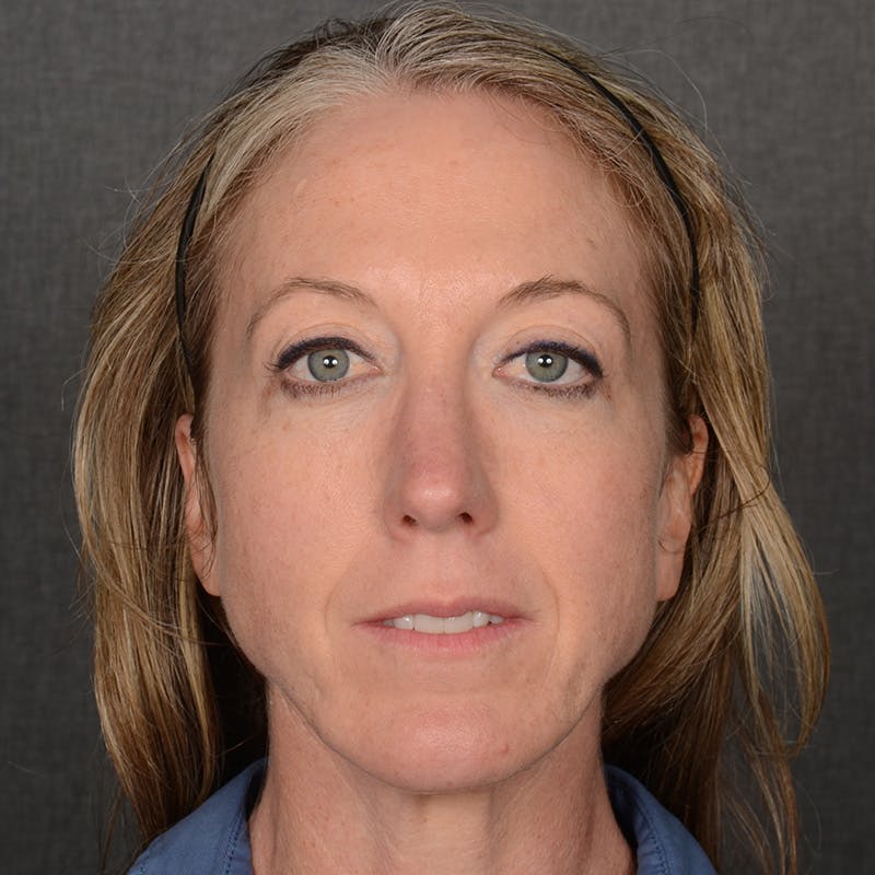 Female Rhinoplasty Before & After Gallery - Patient 262254 - Image 2