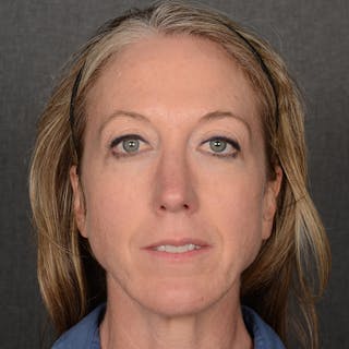 Female Rhinoplasty Before & After Gallery - Patient 262254 - Image 2