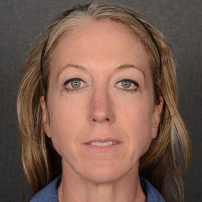 Female Rhinoplasty Before & After Gallery - Patient 262254 - Image 2