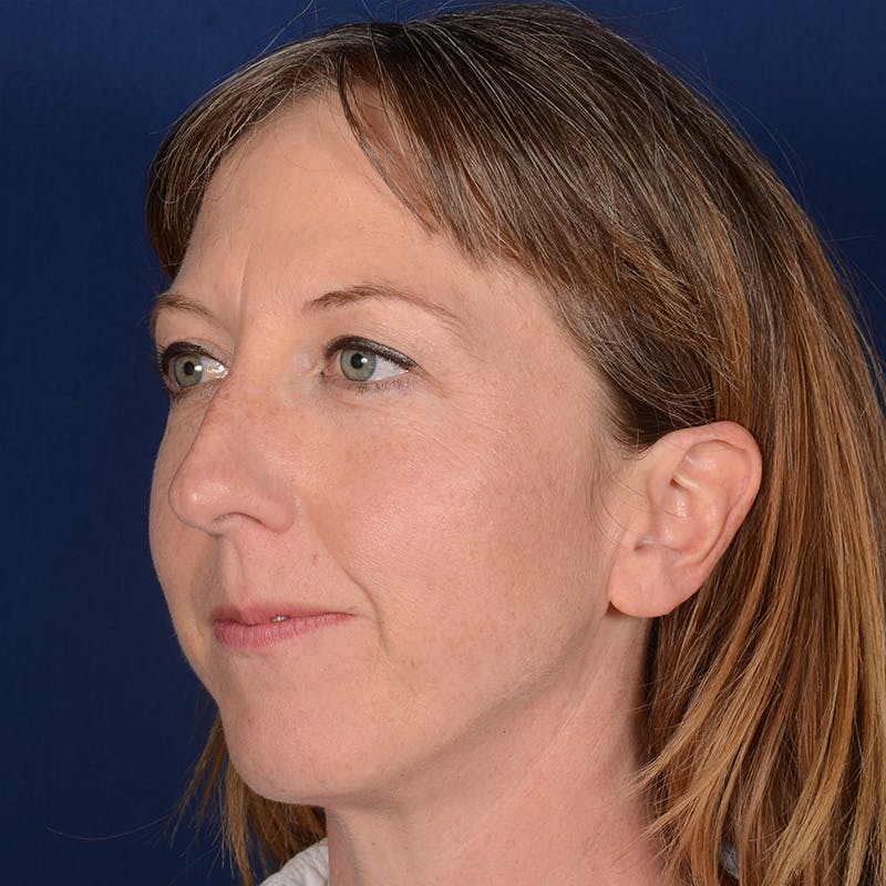 Female Rhinoplasty Before & After Gallery - Patient 262254 - Image 3