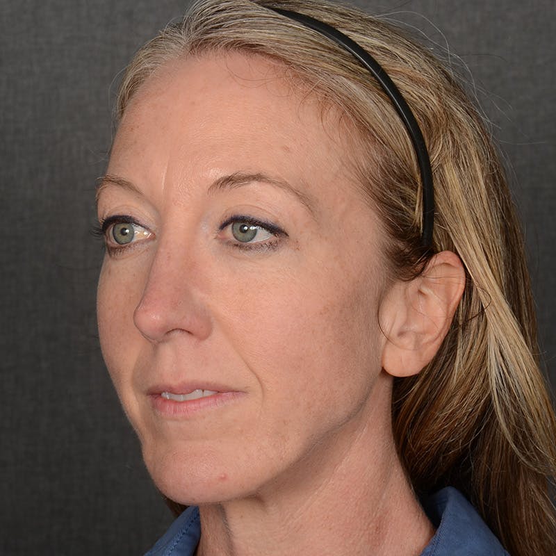 Female Rhinoplasty Before & After Gallery - Patient 262254 - Image 4