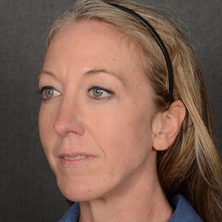 Female Rhinoplasty Before & After Gallery - Patient 262254 - Image 4