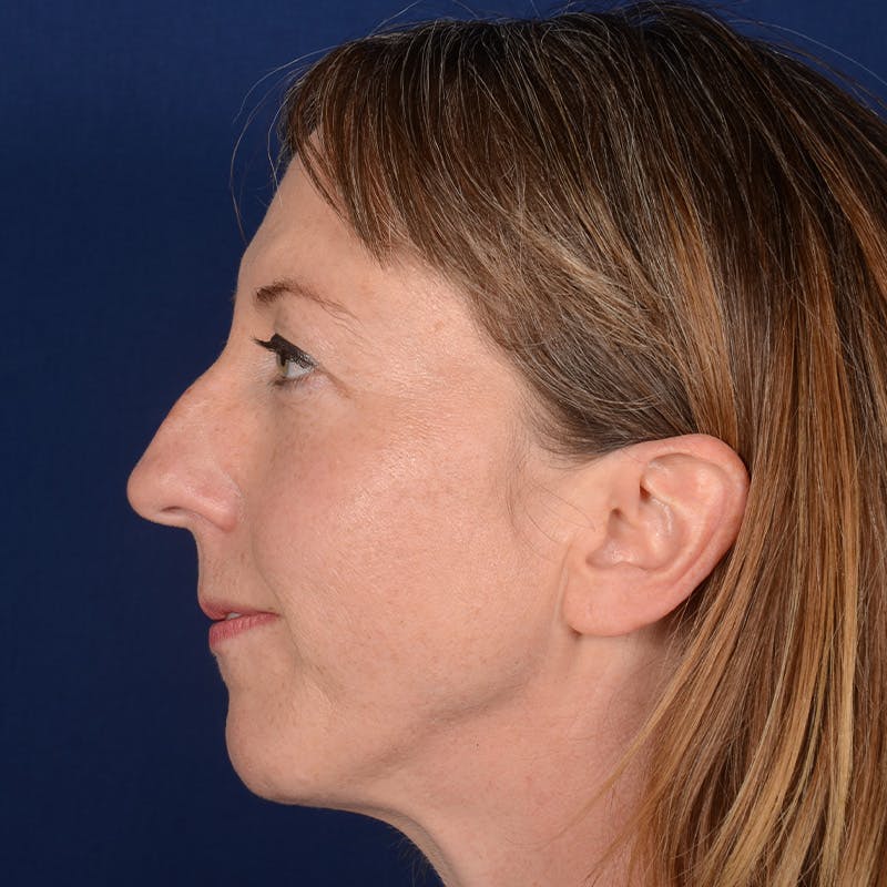 Female Rhinoplasty Before & After Gallery - Patient 262254 - Image 5