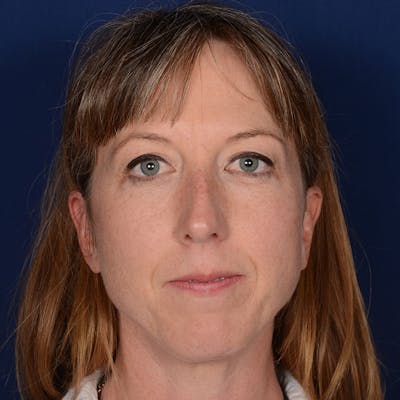 Female Rhinoplasty Before & After Gallery - Patient 262254 - Image 1