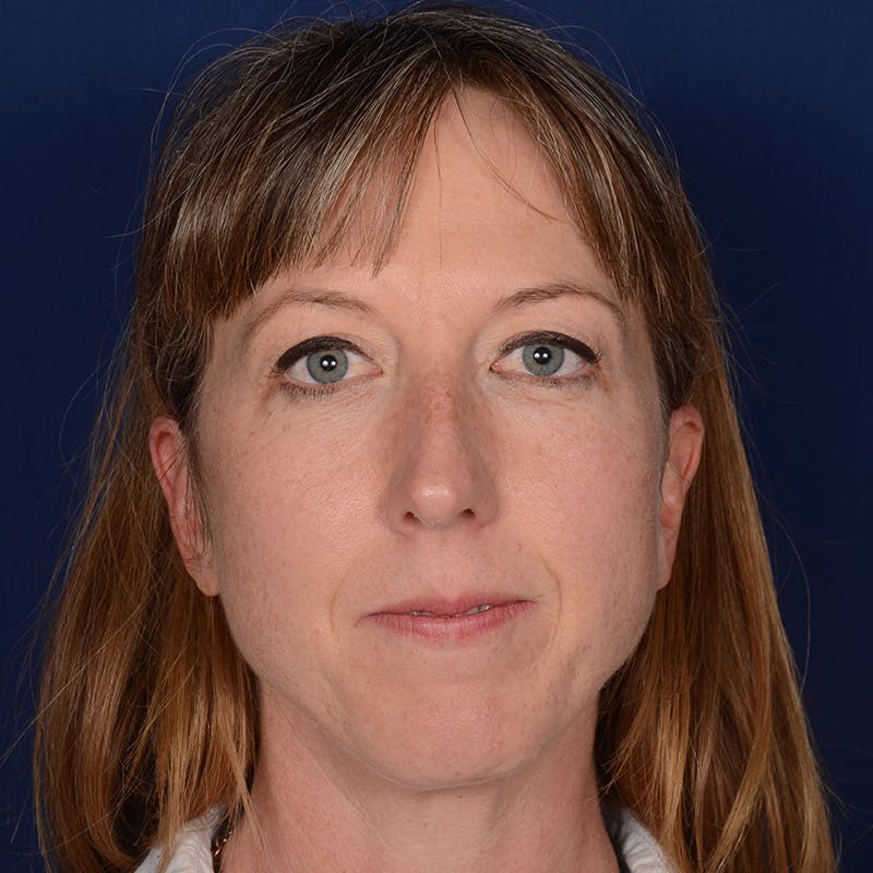 Female Rhinoplasty Before & After Gallery - Patient 262254 - Image 1