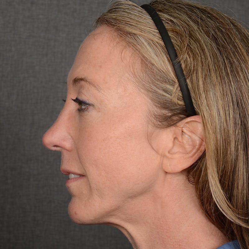 Female Rhinoplasty Before & After Gallery - Patient 262254 - Image 6