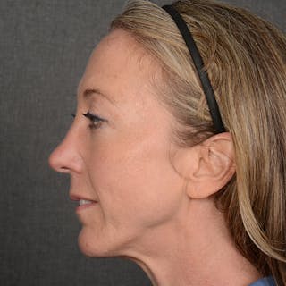 Female Rhinoplasty Before & After Gallery - Patient 262254 - Image 6