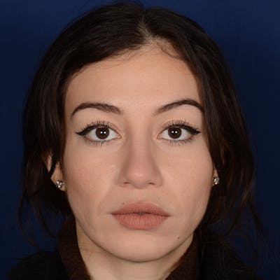 Female Rhinoplasty Before & After Gallery - Patient 419227 - Image 2