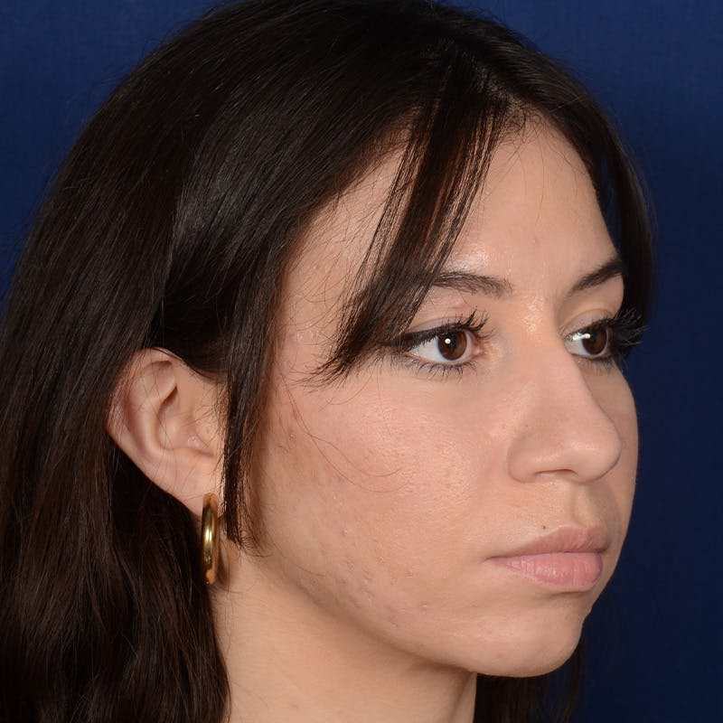 Female Rhinoplasty Before & After Gallery - Patient 419227 - Image 3