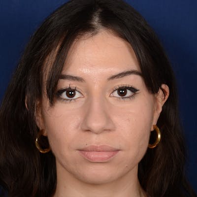 Female Rhinoplasty Before & After Gallery - Patient 419227 - Image 1