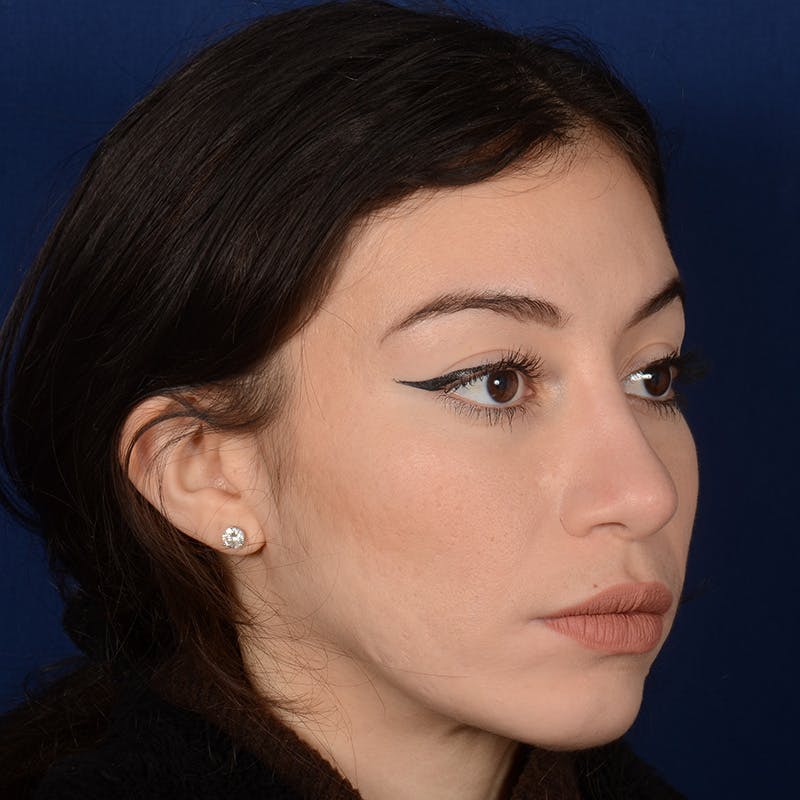 Female Rhinoplasty Before & After Gallery - Patient 419227 - Image 4