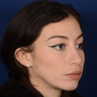 Female Rhinoplasty Before & After Gallery - Patient 419227 - Image 4