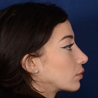 Female Rhinoplasty Before & After Gallery - Patient 419227 - Image 6