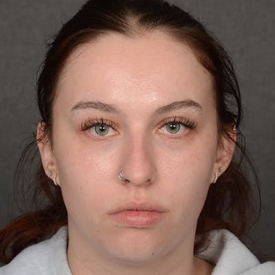 Female Rhinoplasty Before & After Gallery - Patient 391658 - Image 1