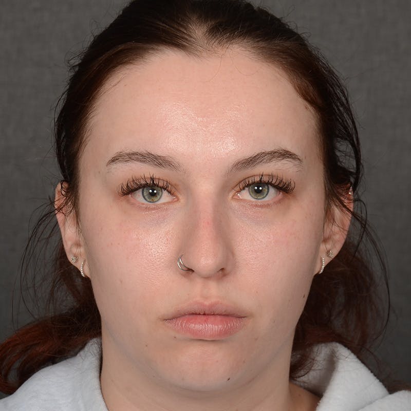 Female Rhinoplasty Before & After Gallery - Patient 391658 - Image 1