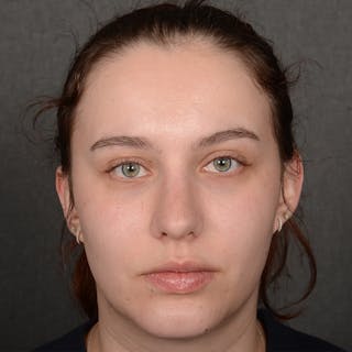 Female Rhinoplasty Before & After Gallery - Patient 391658 - Image 2