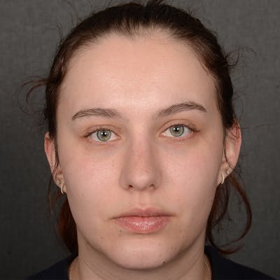 Female Rhinoplasty Before & After Gallery - Patient 391658 - Image 2