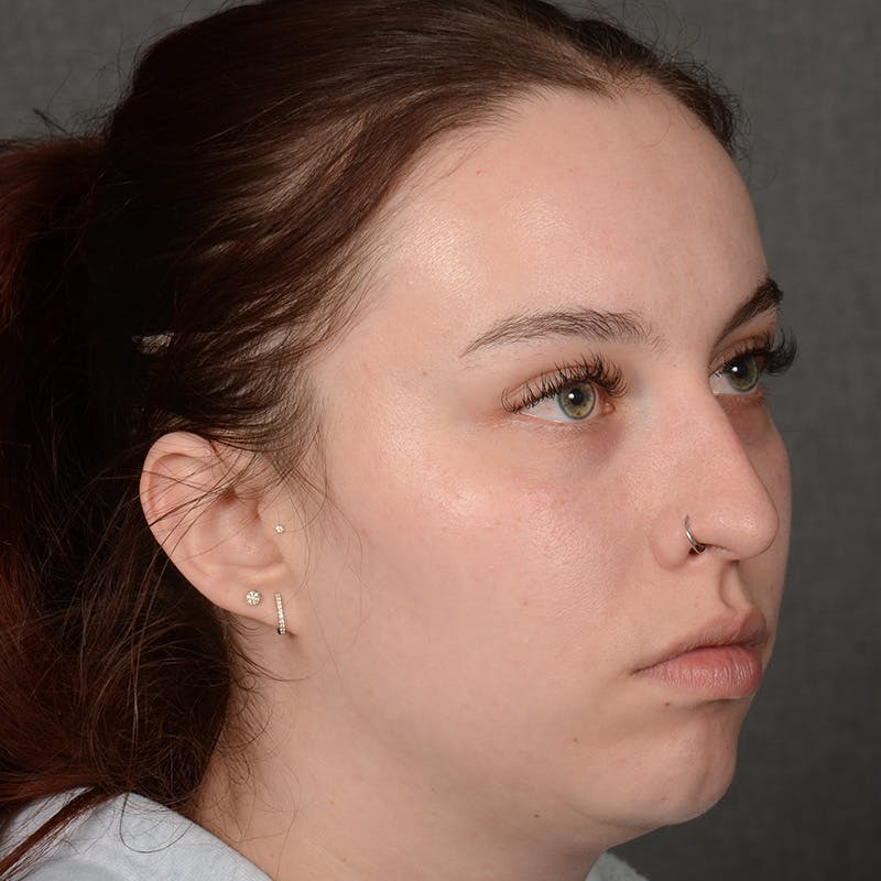 Female Rhinoplasty Before & After Gallery - Patient 391658 - Image 3