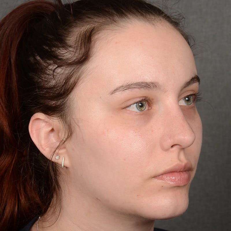 Female Rhinoplasty Before & After Gallery - Patient 391658 - Image 4