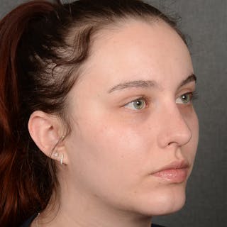 Female Rhinoplasty Before & After Gallery - Patient 391658 - Image 4