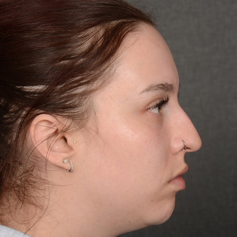 Female Rhinoplasty Before & After Gallery - Patient 391658 - Image 5