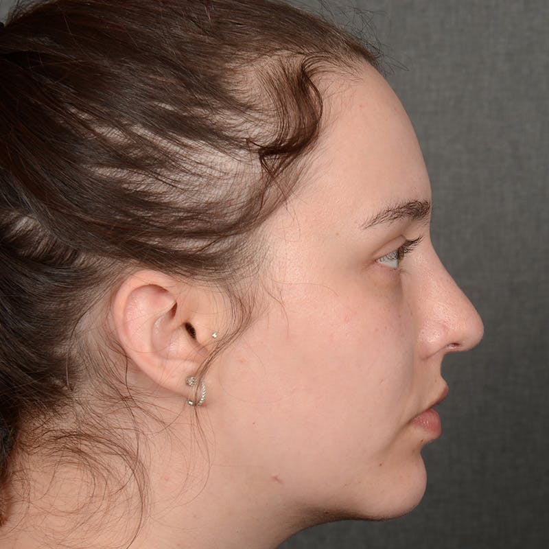 Female Rhinoplasty Before & After Gallery - Patient 391658 - Image 6