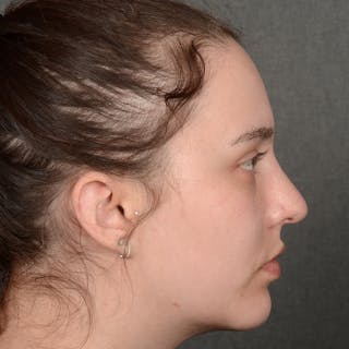 Female Rhinoplasty Before & After Gallery - Patient 391658 - Image 6