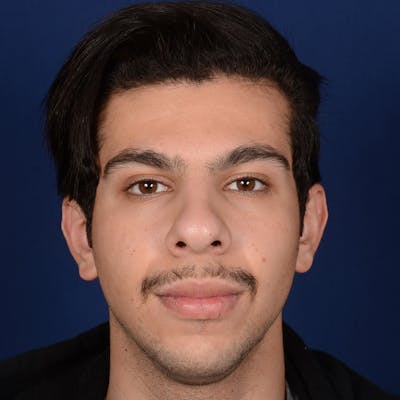 Male Rhinoplasty Before & After Gallery - Patient 873958 - Image 1