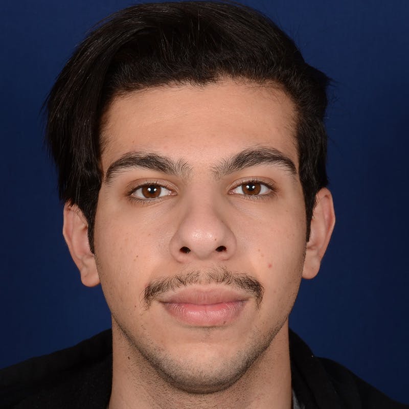 Male Rhinoplasty Before & After Gallery - Patient 873958 - Image 1