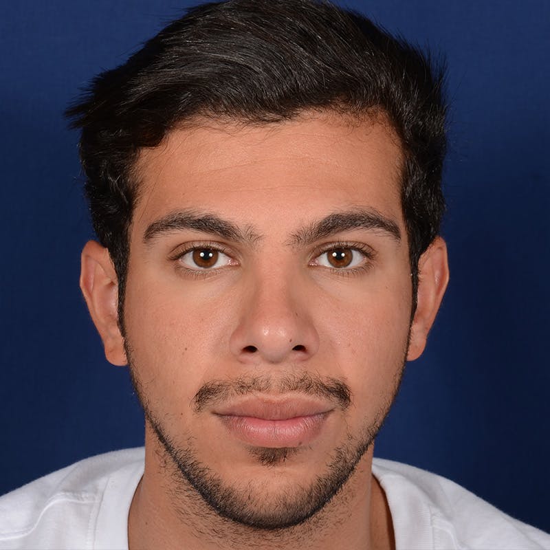 Male Rhinoplasty Before & After Gallery - Patient 873958 - Image 2