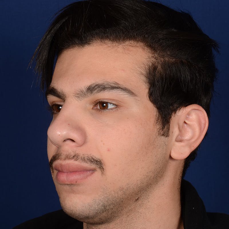 Male Rhinoplasty Before & After Gallery - Patient 873958 - Image 3
