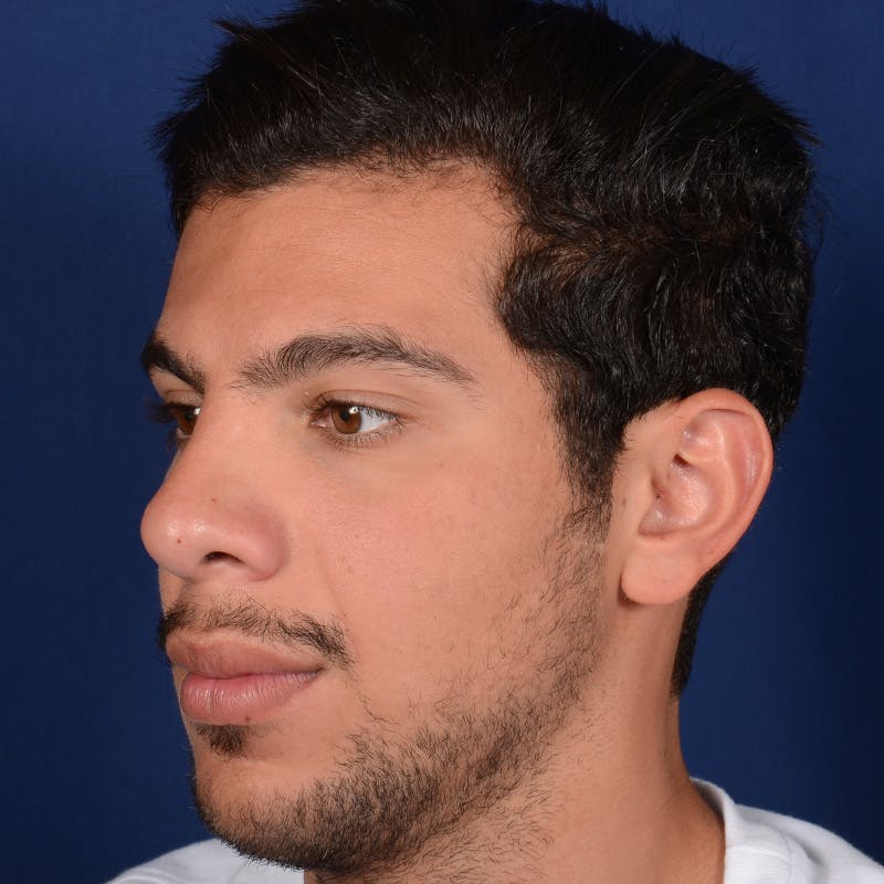 Male Rhinoplasty Before & After Gallery - Patient 873958 - Image 4