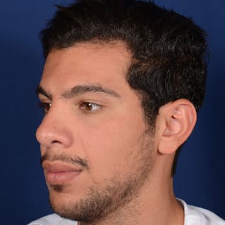 Male Rhinoplasty Before & After Gallery - Patient 873958 - Image 4