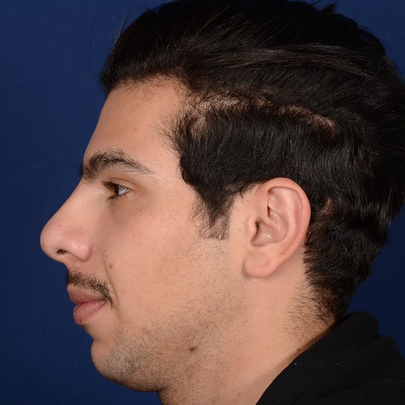 Male Rhinoplasty Before & After Gallery - Patient 873958 - Image 5