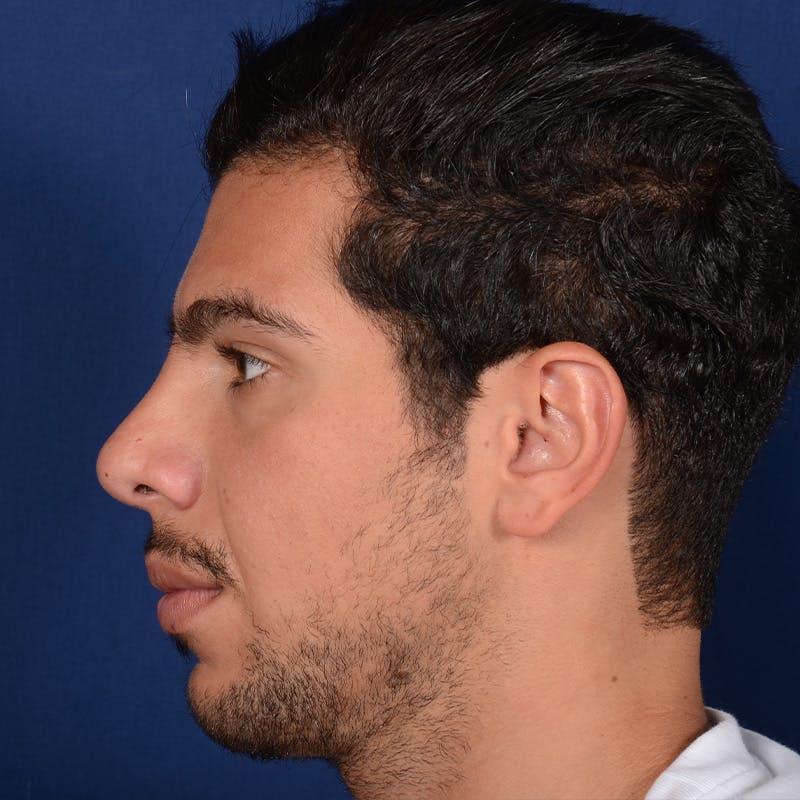 Male Rhinoplasty Before & After Gallery - Patient 873958 - Image 6