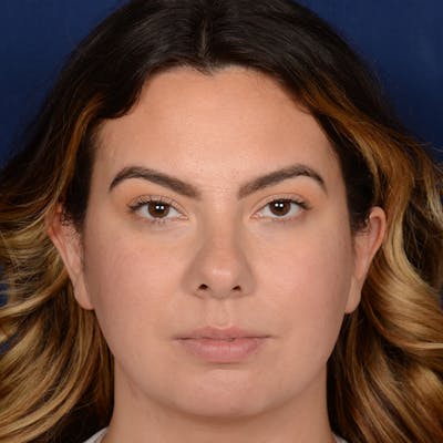 Female Rhinoplasty Before & After Gallery - Patient 520656 - Image 1