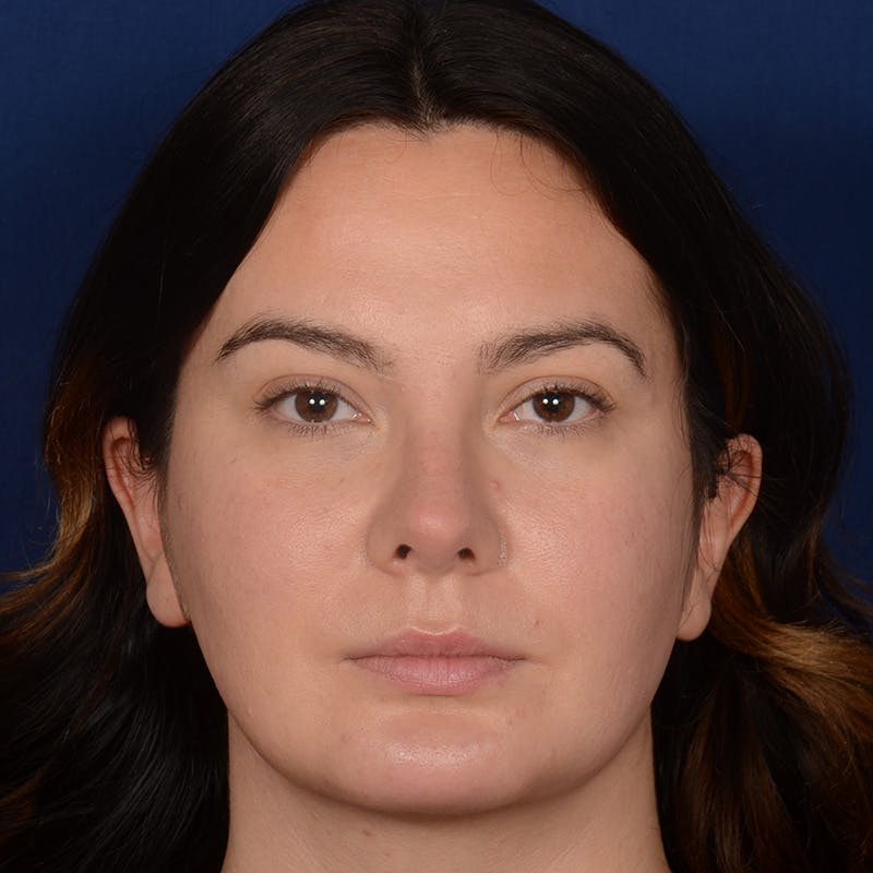 Female Rhinoplasty Before & After Gallery - Patient 520656 - Image 2