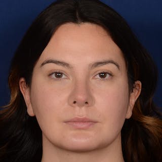 Female Rhinoplasty Before & After Gallery - Patient 520656 - Image 2