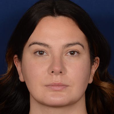 Female Rhinoplasty Before & After Gallery - Patient 520656 - Image 2