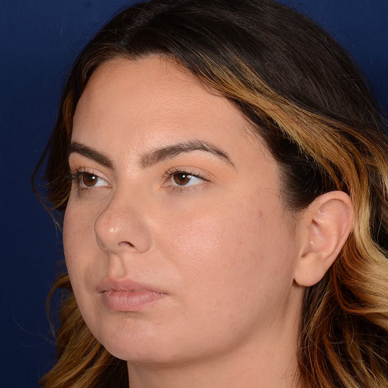 Female Rhinoplasty Before & After Gallery - Patient 520656 - Image 3