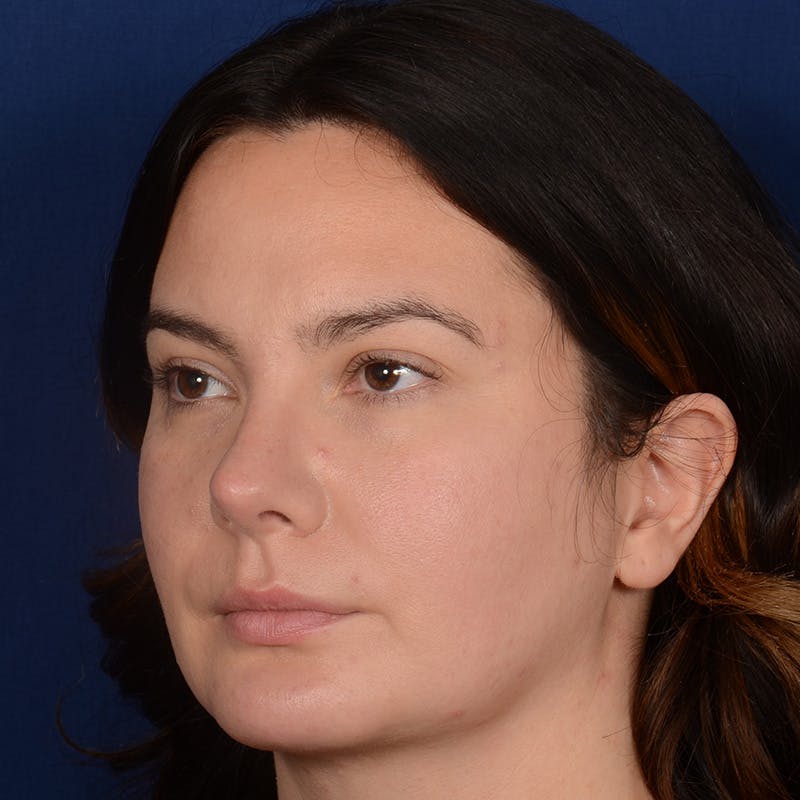 Female Rhinoplasty Before & After Gallery - Patient 520656 - Image 4