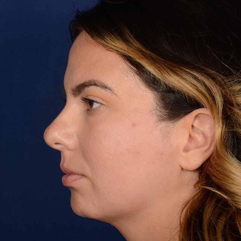Female Rhinoplasty Before & After Gallery - Patient 520656 - Image 5