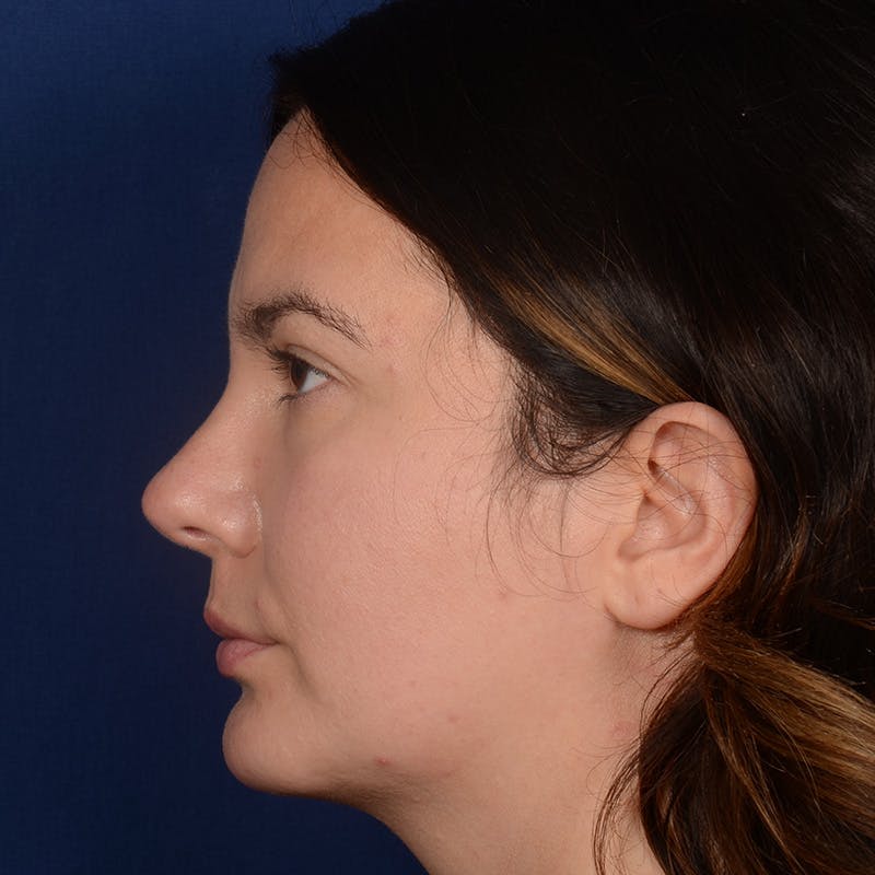 Female Rhinoplasty Before & After Gallery - Patient 520656 - Image 6