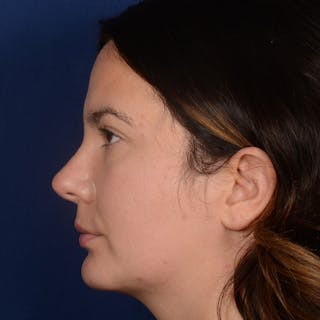 Female Rhinoplasty Before & After Gallery - Patient 520656 - Image 6